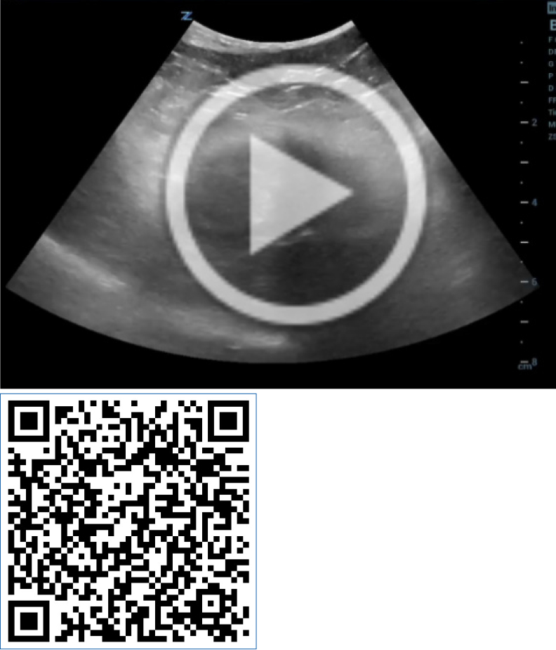 Vídeo 1. Vídeo ecográfico de la lesión duodenal. A través de este QR puedes visualizar la ecografía.